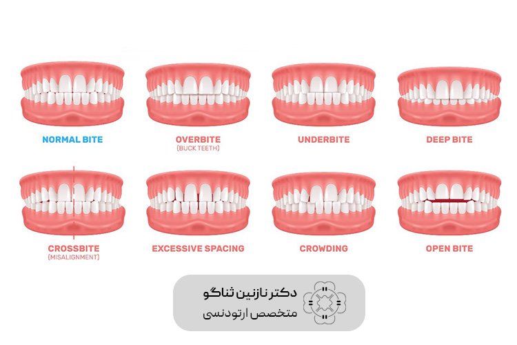 اختلالات-ناشی-از-ناهنجاری-فک