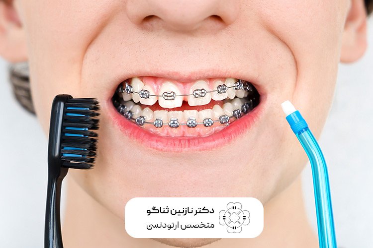 نحوه رعایت بهداشت دهان و دندان در زمان ارتودنسی