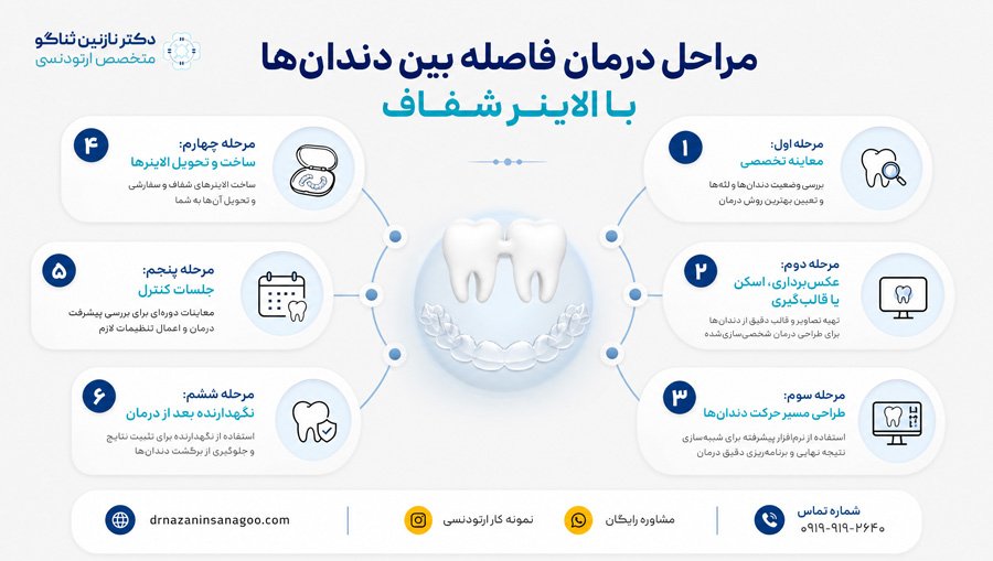 مراحل درمان فاصله بین دندان‌ها با الاینر شفاف