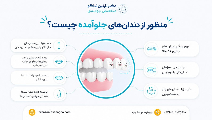 منظور از دندان‌های جلوآمده چیست؟