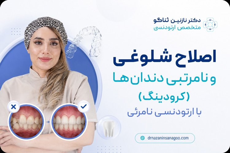 اصلاح شلوغی و نامرتبی دندان‌ها (کرودینگ) با ارتودنسی نامرئی