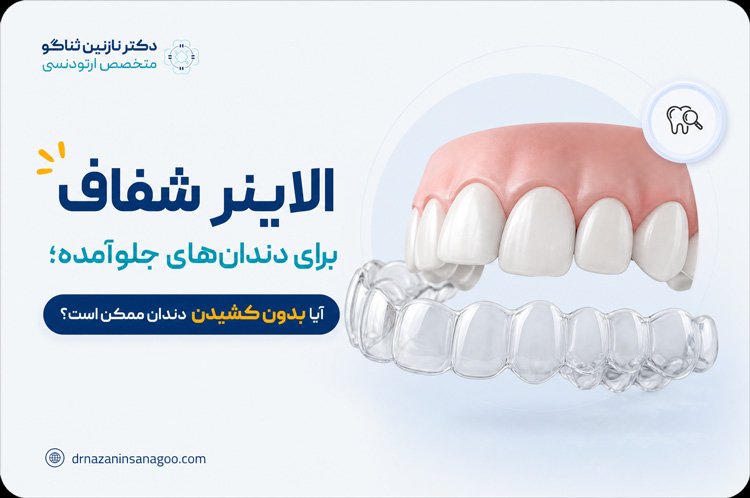 الاینر شفاف برای دندان‌های جلوآمده